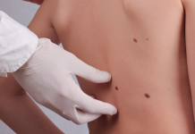 «La Importancia de la Revisión Anual de Lunares: Detectando el Cáncer de Piel a Tiempo»