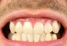 ¿Aprietas mucho los dientes? Conoce la relación entre el bruxismo y el estrés