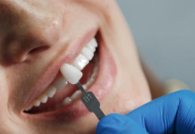 Carillas dentales: ¿Cuándo recurrir a este diseño de sonrisa y cuáles son sus riesgos?