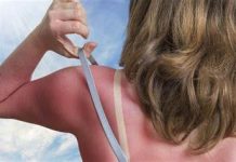 Errores comunes al tratar una quemadura solar y cómo evitarlos