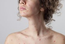 EsSalud: Varicela en Adultos, ¿Más Grave que en Niños?